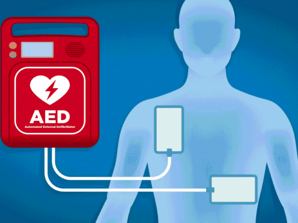 Illustration of an AED (automated external defibrillator) with its pads connected to the chest of a person